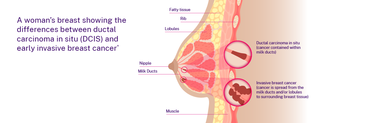 Infographic or illustration showing areas if the breast, DCIS and early stages of breast cancer